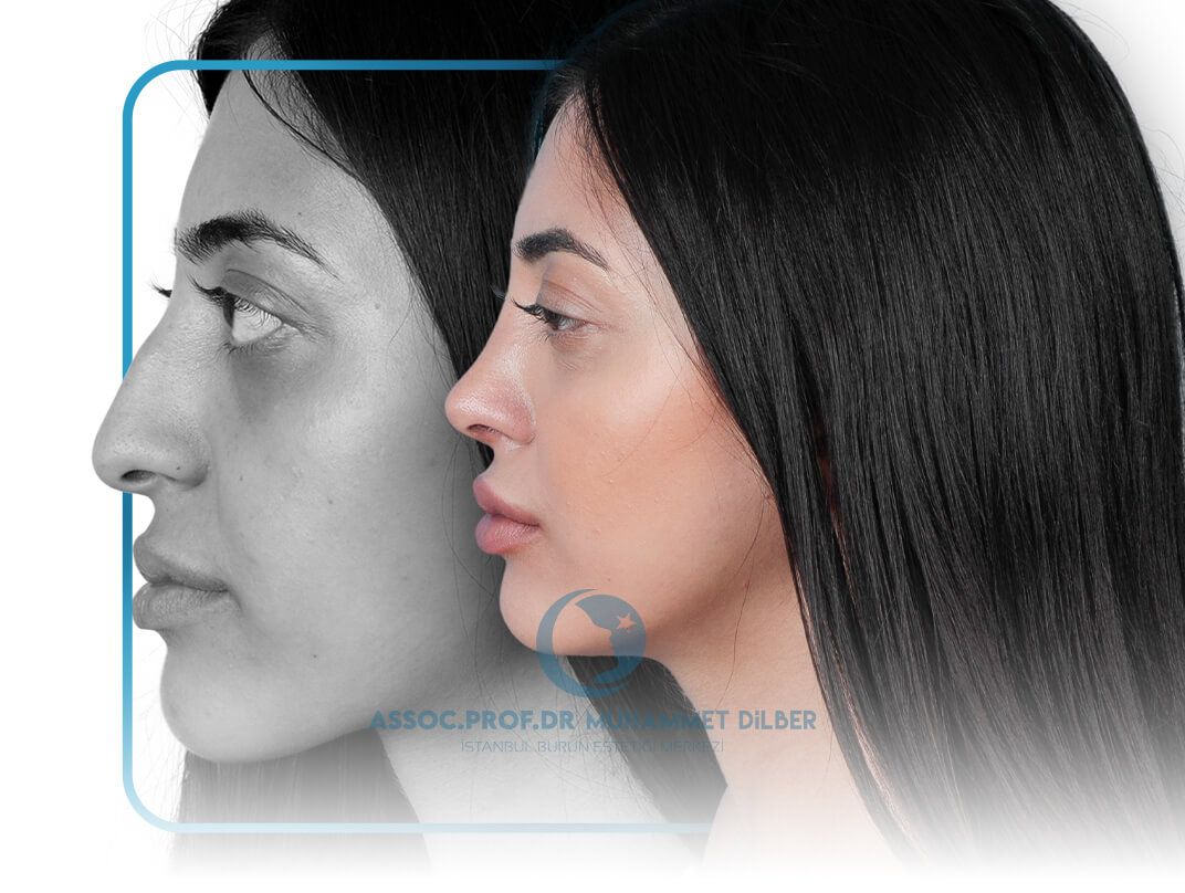 rhinoplasty istanbul - nose job istanbul