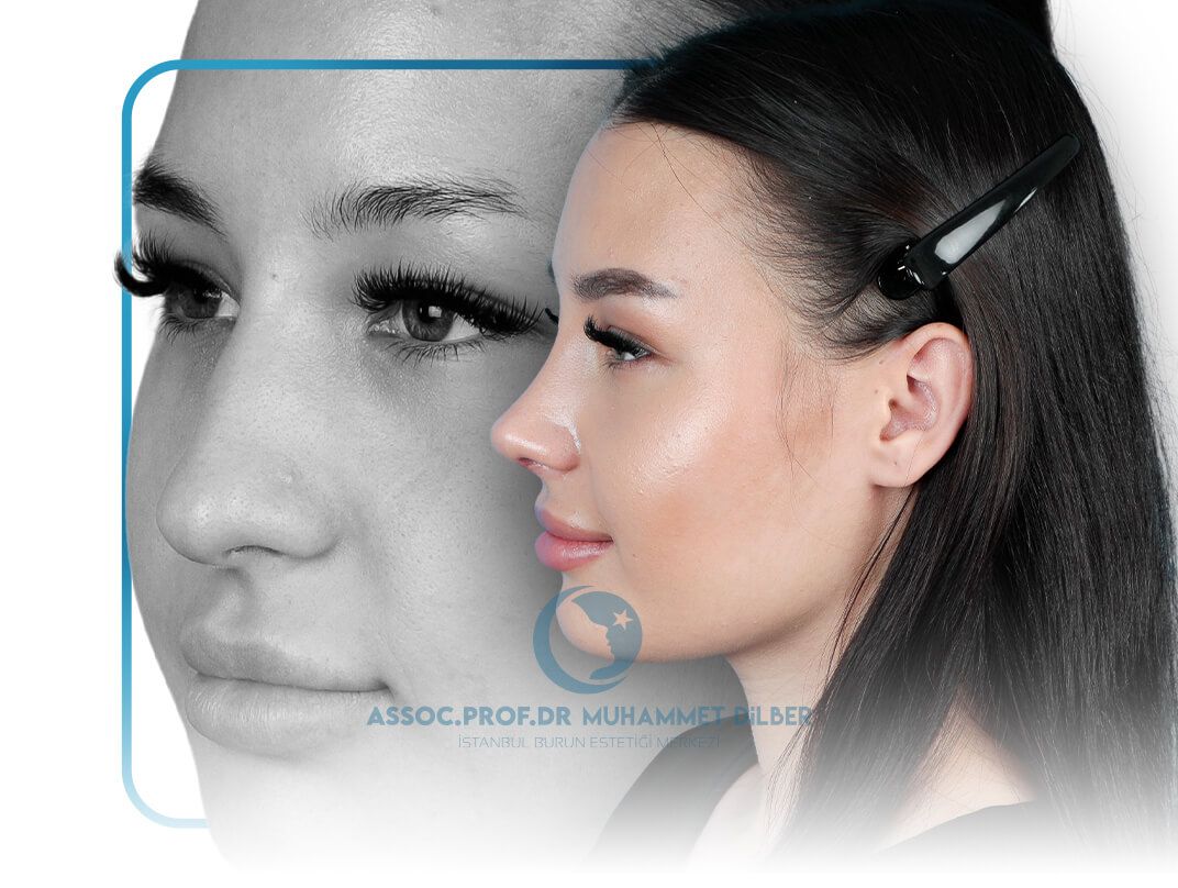 Ultrasonic Rhinoplasty Turkey - before after